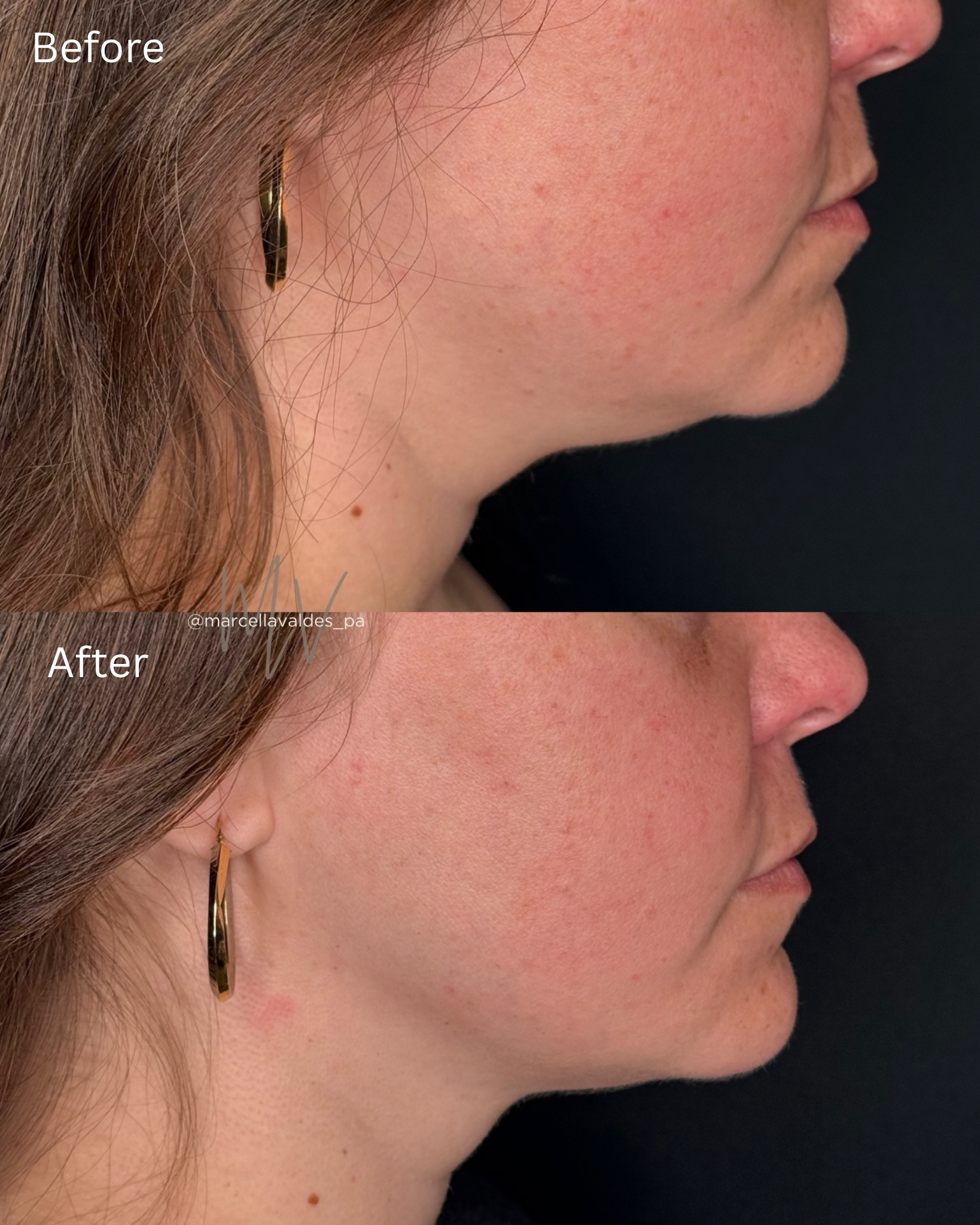 Submental Liquid Lipo before and after — EMVEE Medspa Coral Gables