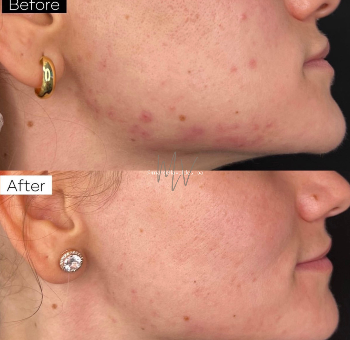 Skin acne improvement PRF before and after — EMVEE Medspa Coral Gables