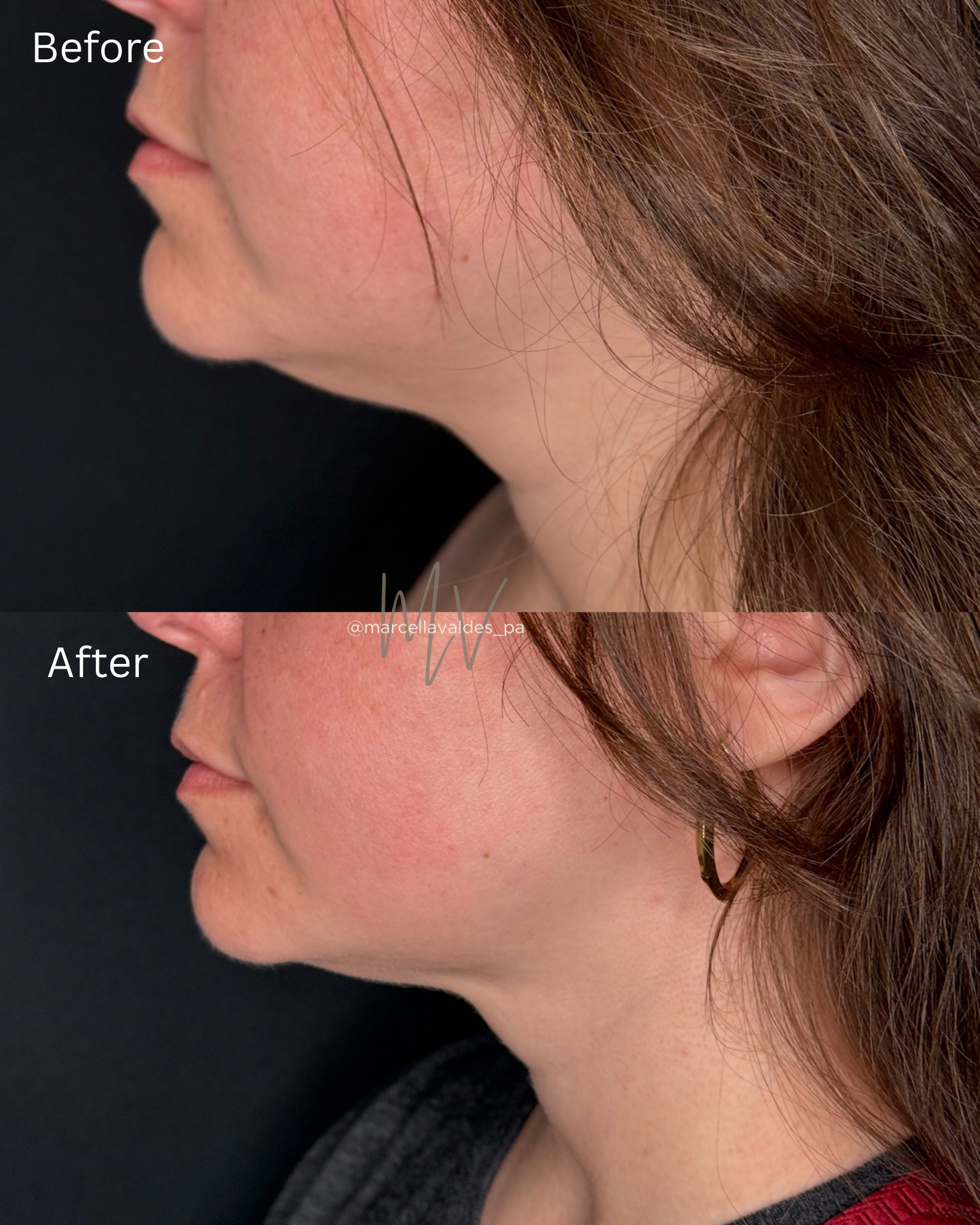 Submental Liquid Lipo before and after — EMVEE Medspa Coral Gables