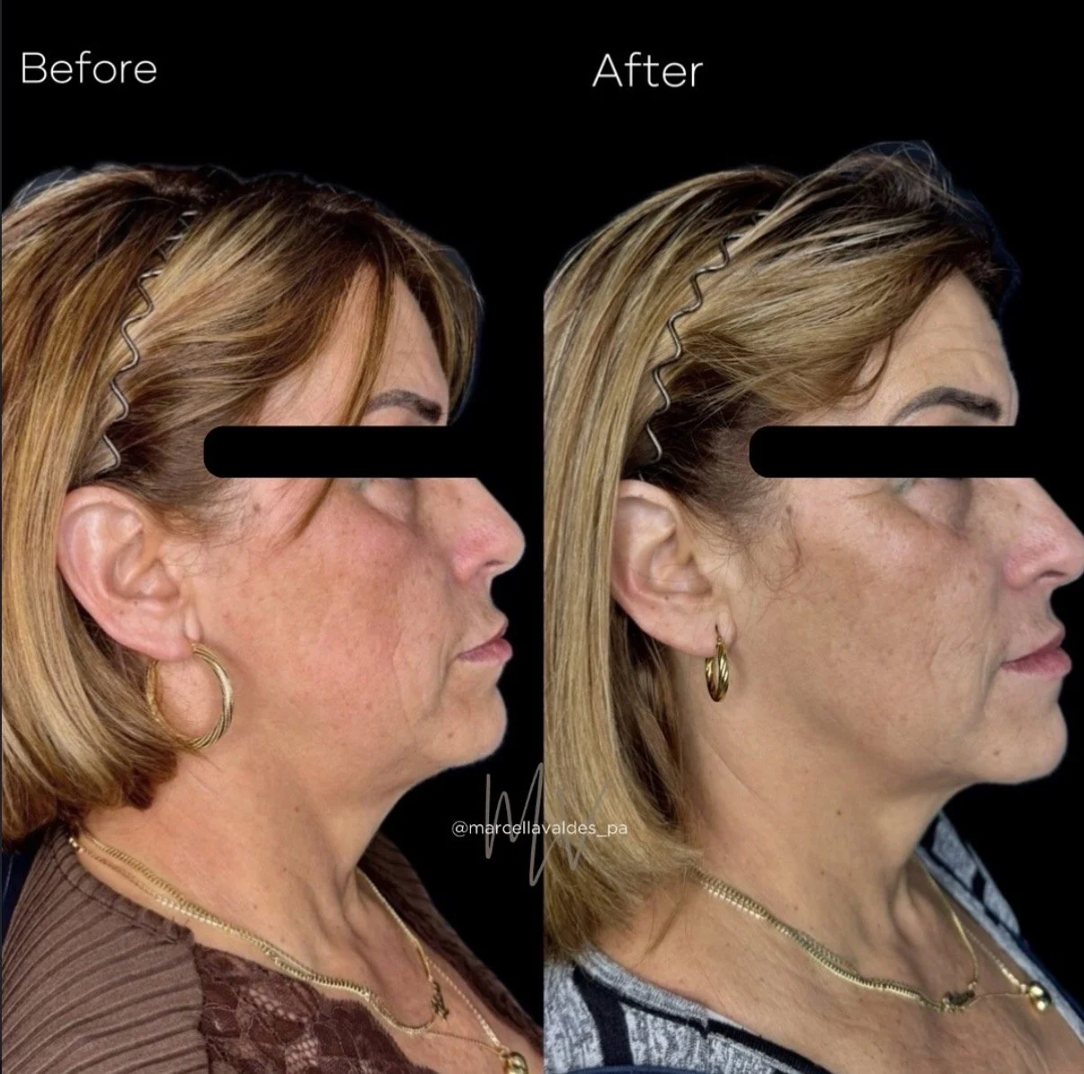 Sculptra to face before and after — EMVEE Medspa Coral Gables