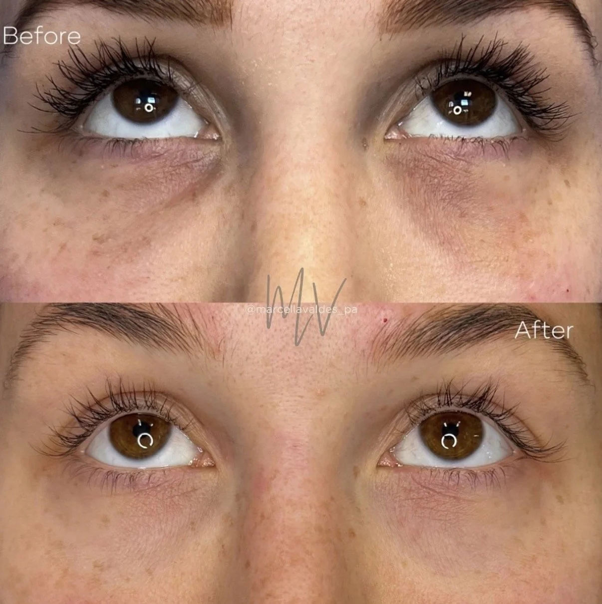 Undereye PRF before and after — EMVEE Medspa Coral Gables