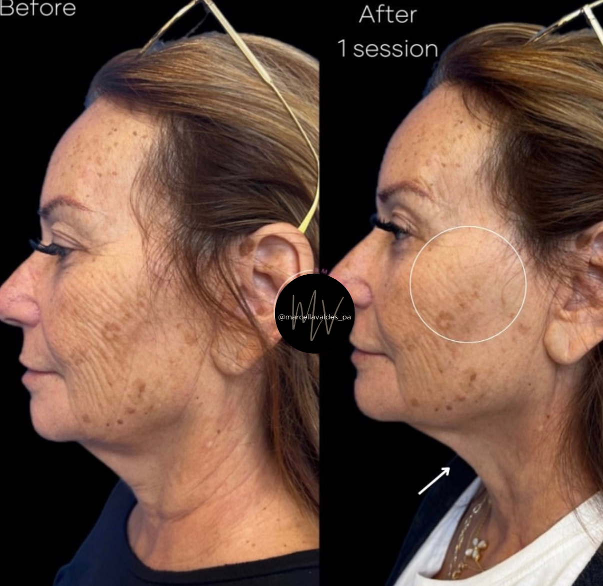 Morpheus8 face and neck before and after — EMVEE Medspa Coral Gables