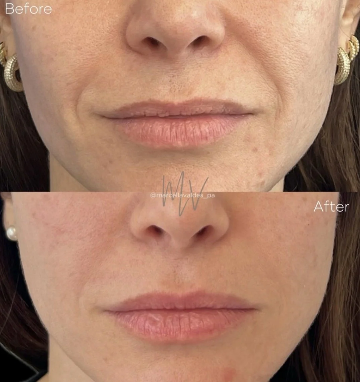 Sculptra to face before and after — EMVEE Medspa Coral Gables