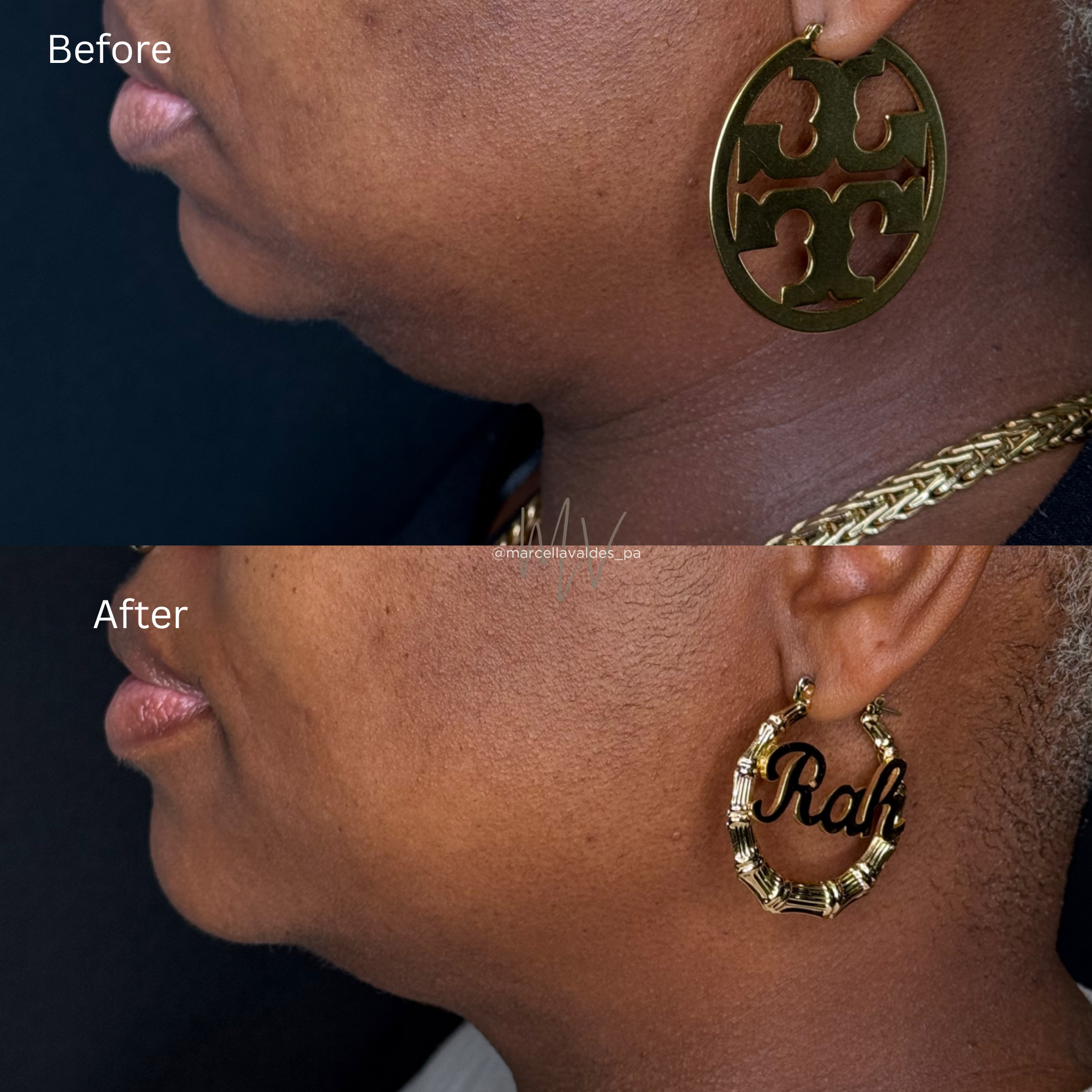 Submental Liquid Lipo before and after — EMVEE Medspa Coral Gables