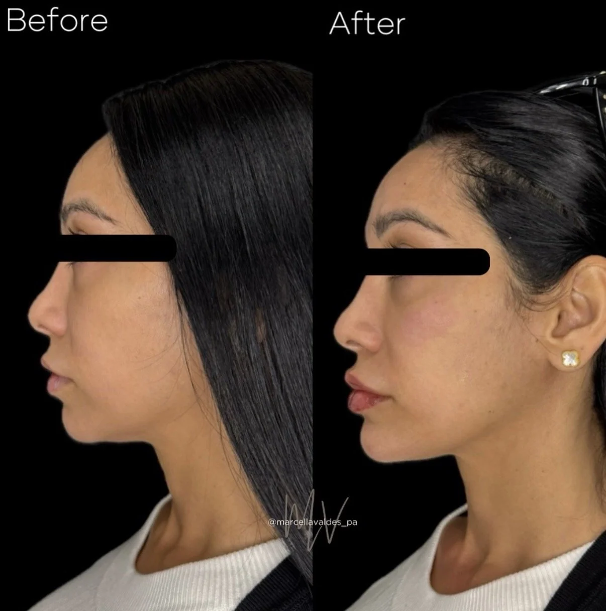 Cheek, lip and chin filler before and after — EMVEE Medspa Coral Gables