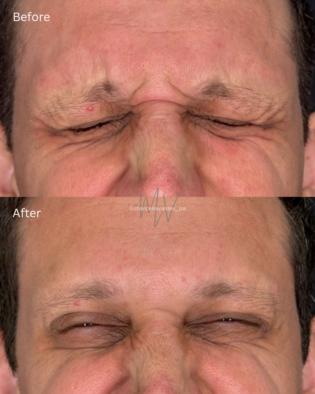 Glabella Botox results, frown line softening — EMVEE Medspa Coral Gables