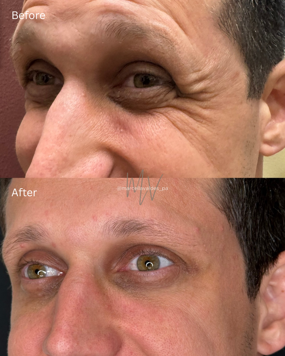 Crows feet Botox before and after — EMVEE Medspa Coral Gables
