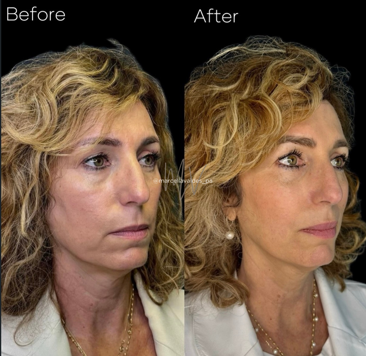 Sculptra and Morpheus8 combo before and after — EMVEE Medspa Coral Gables