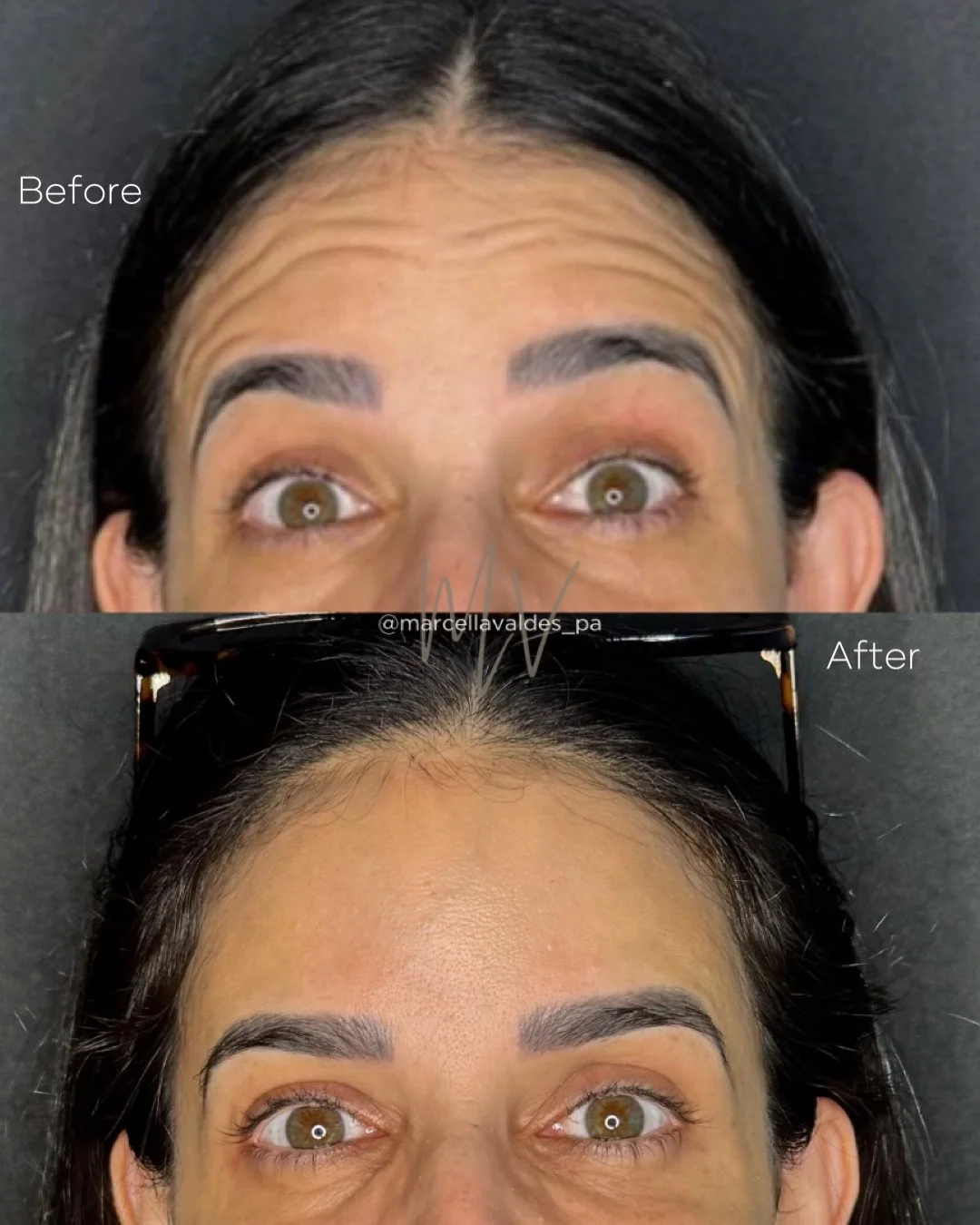 Forehead Botox before and after — EMVEE Medspa Coral Gables
