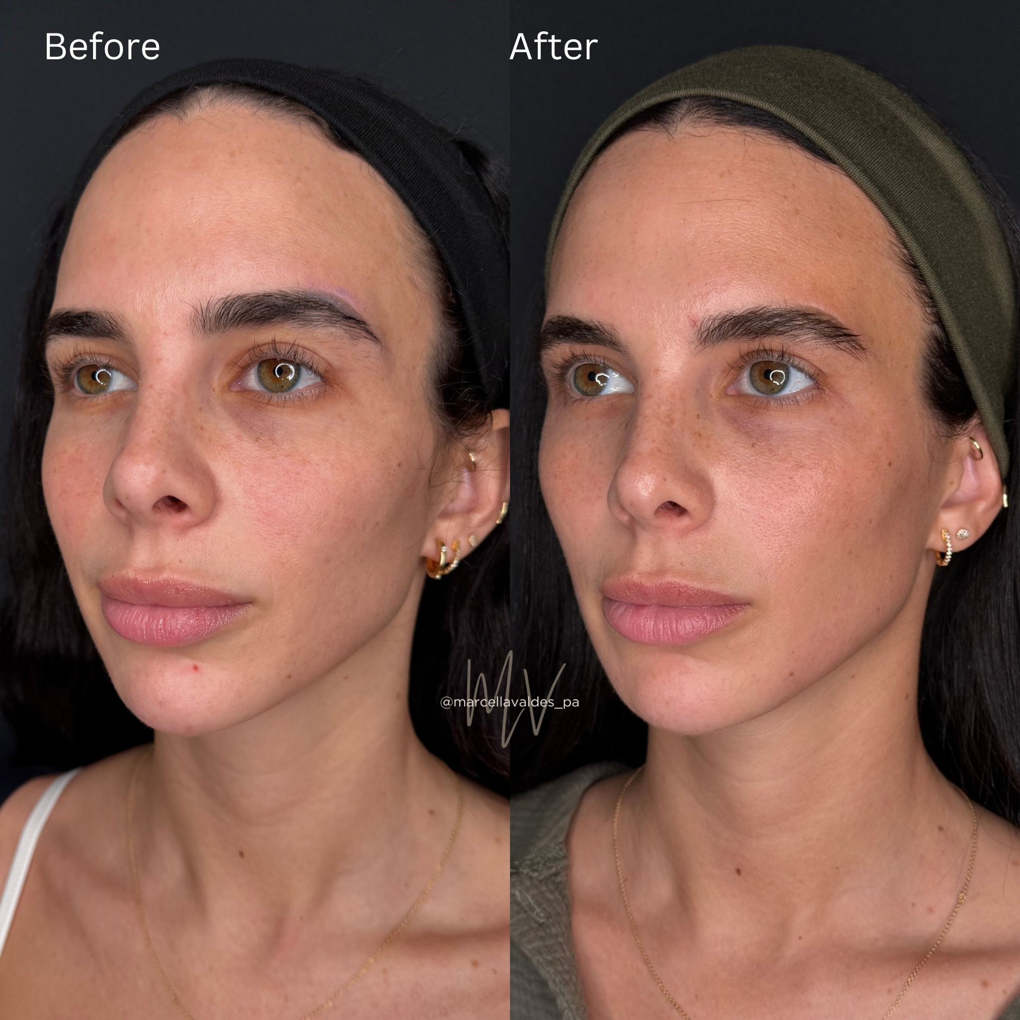 Sculptra to face before and after — EMVEE Medspa Coral Gables