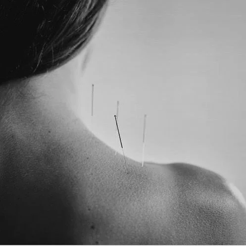 Acupuncture
