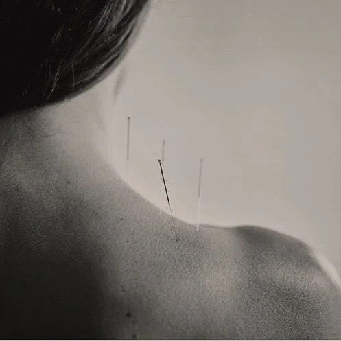 Acupuncture