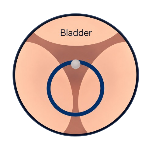 Bipolar TURP resection geometry