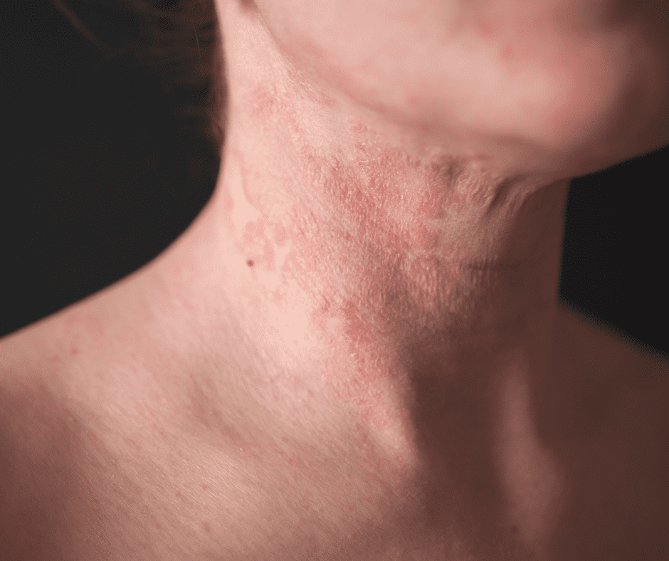 Illustrative eczema patch on the neck