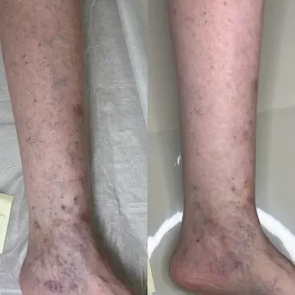 Spider vein removal results Western North Carolina Well Aesthetics