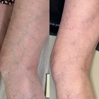Sclerotherapy before and after spider vein results Waynesville NC Well Aesthetics