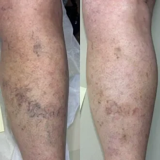 Sclerotherapy leg vein results Well Aesthetics Waynesville NC