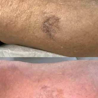 Spider vein treatment results Waynesville NC Well Aesthetics