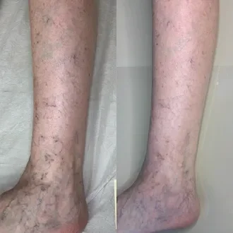 Sclerotherapy results Haywood County NC Well Aesthetics