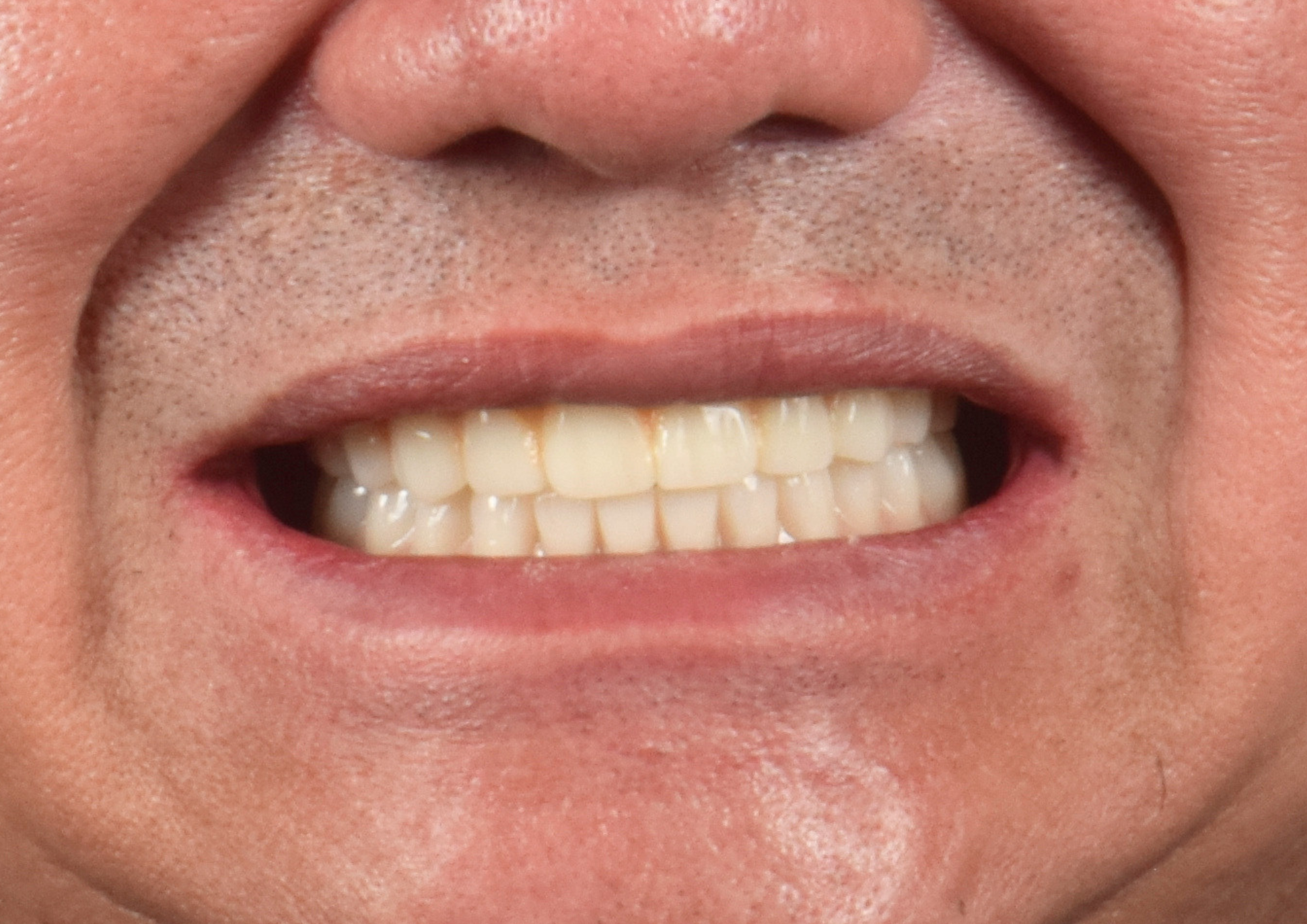 After dental treatment
