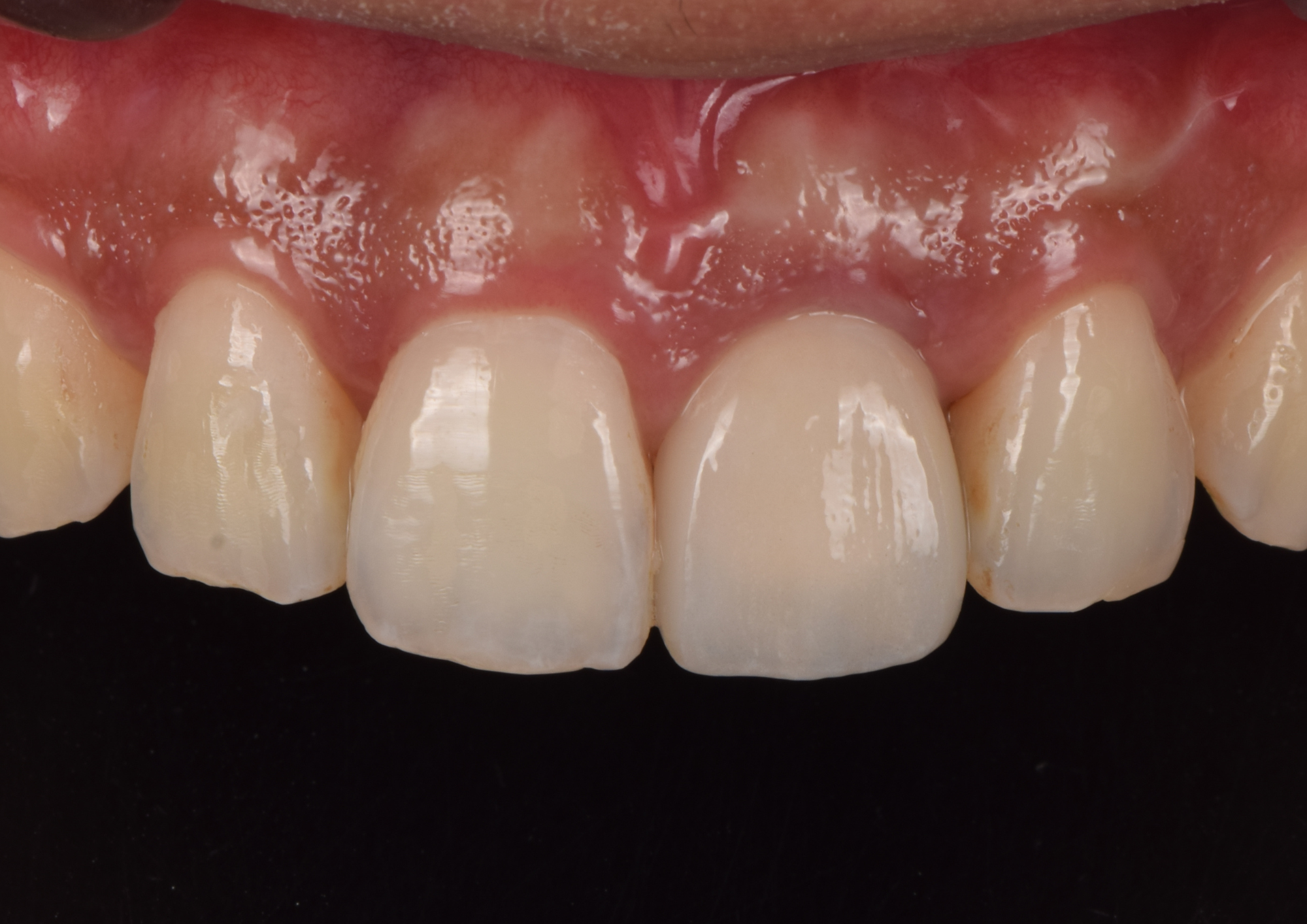 After dental treatment