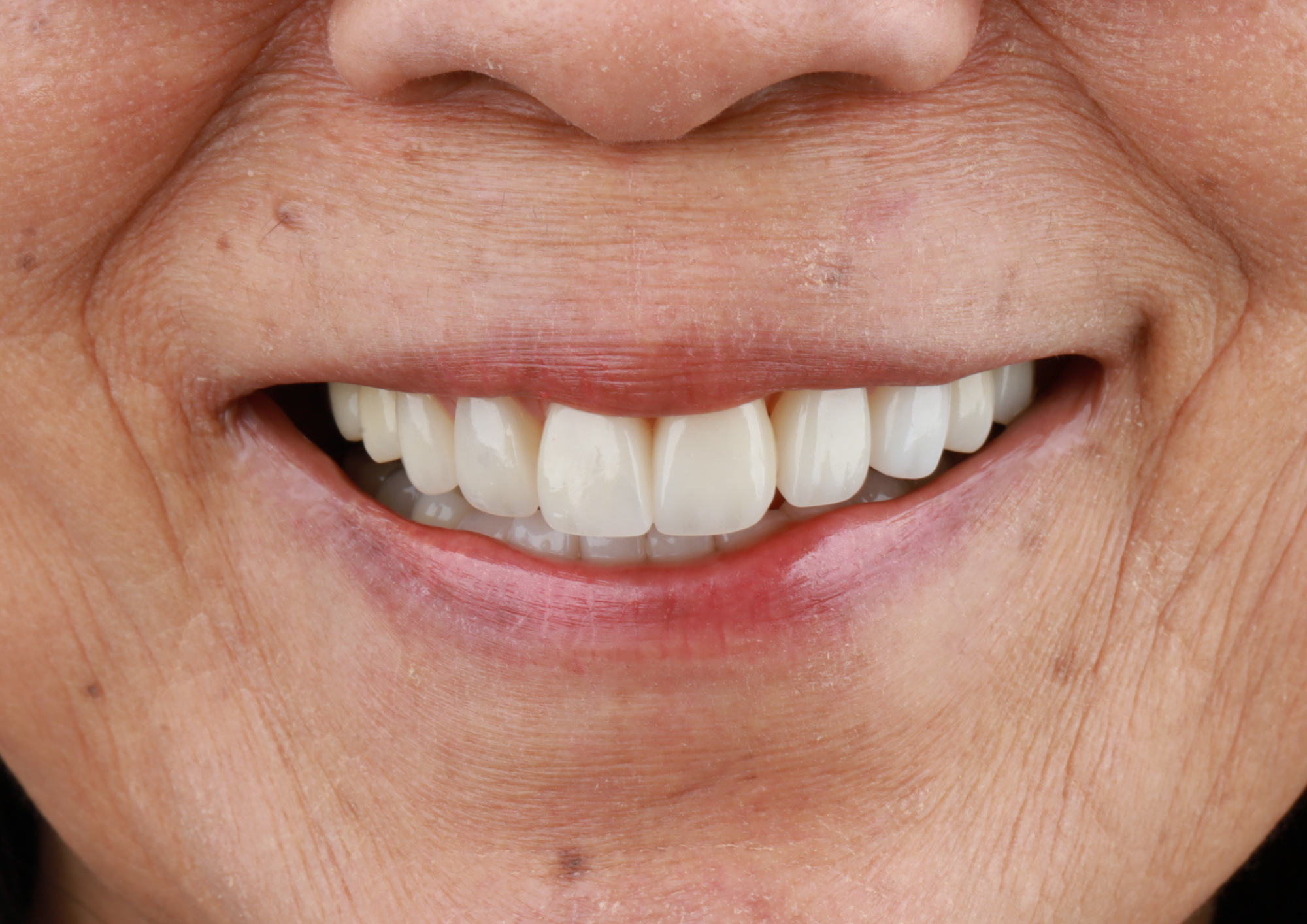 After dental treatment