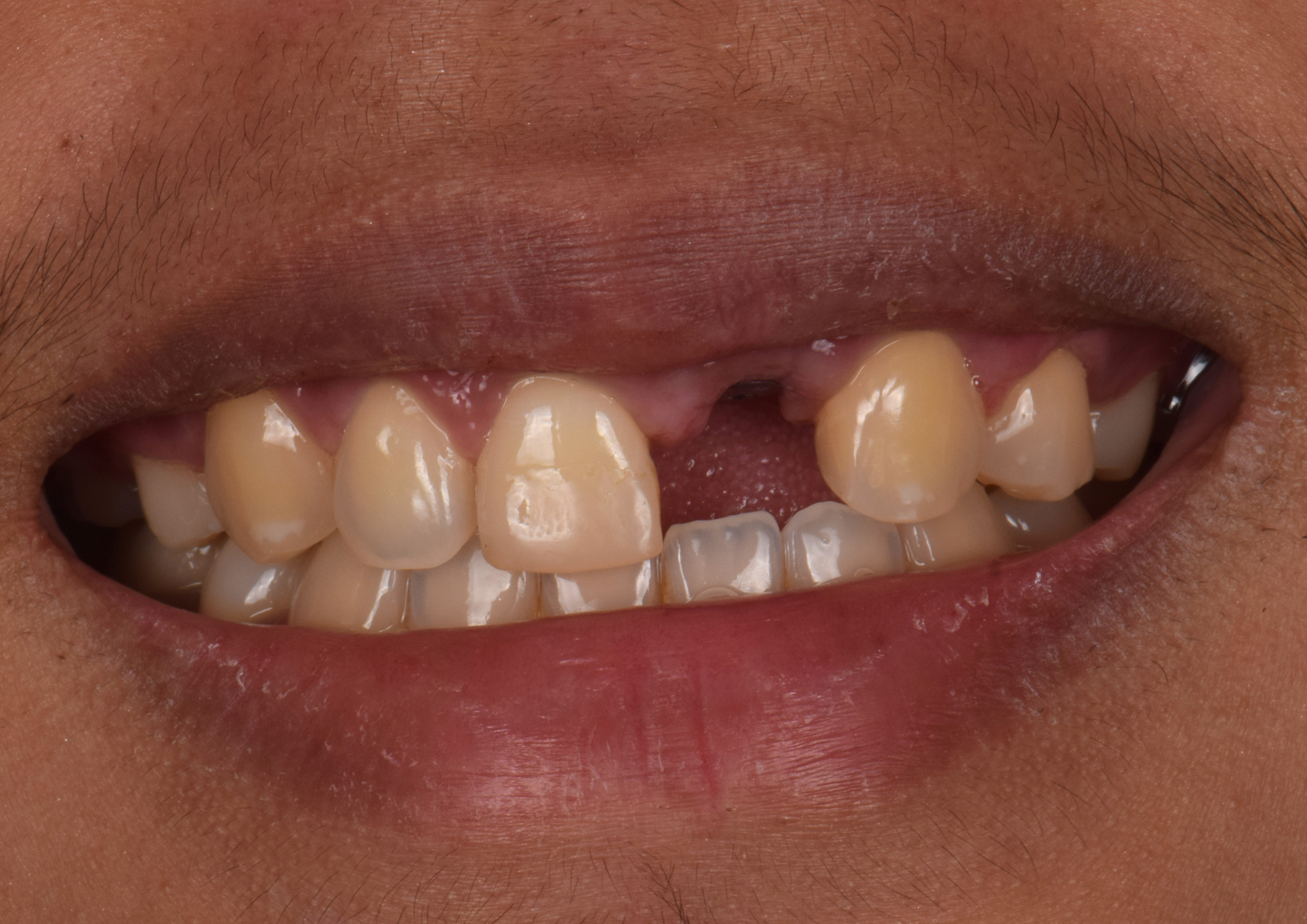 Before treatment