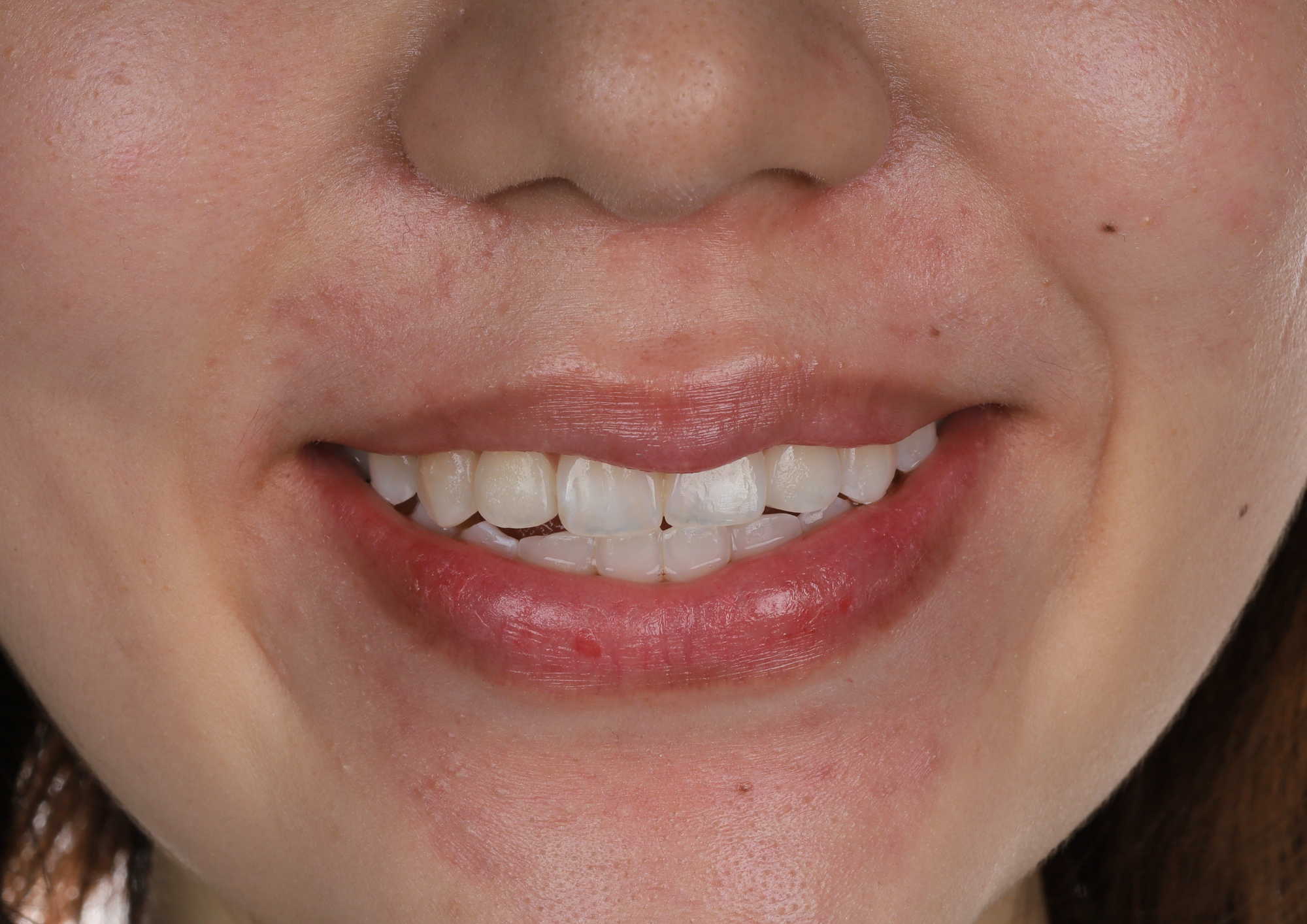 Before treatment