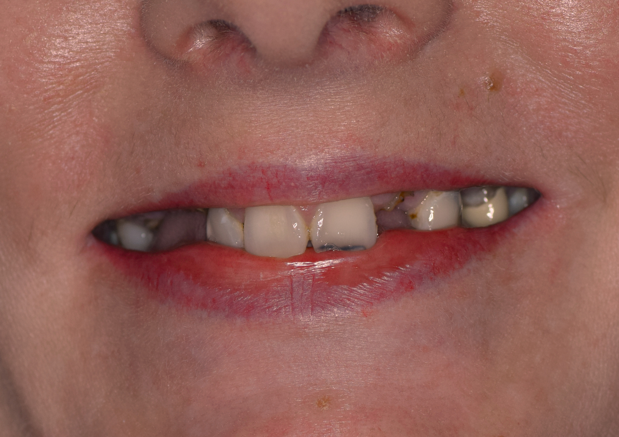 Before treatment