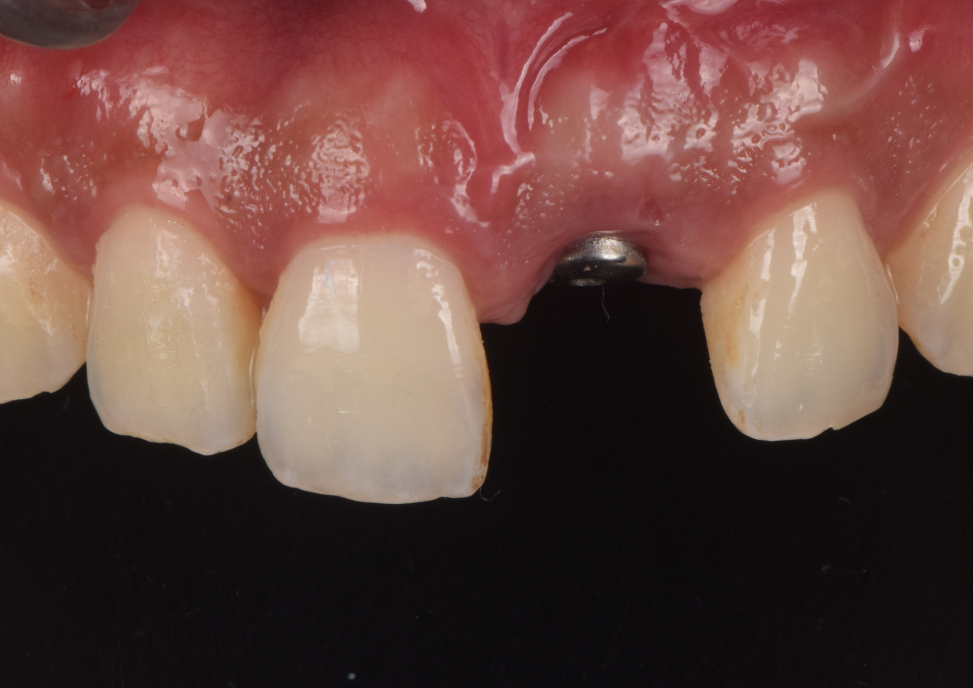 Before treatment