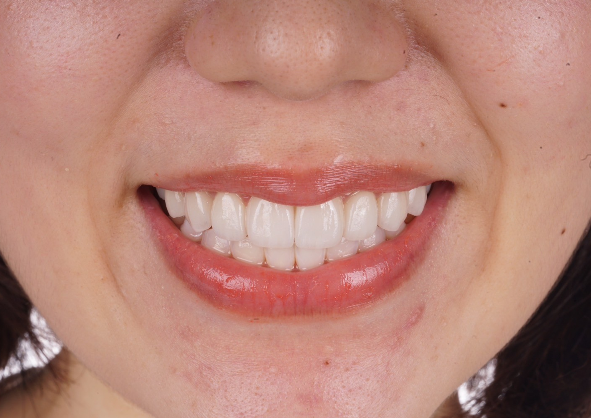 After dental treatment