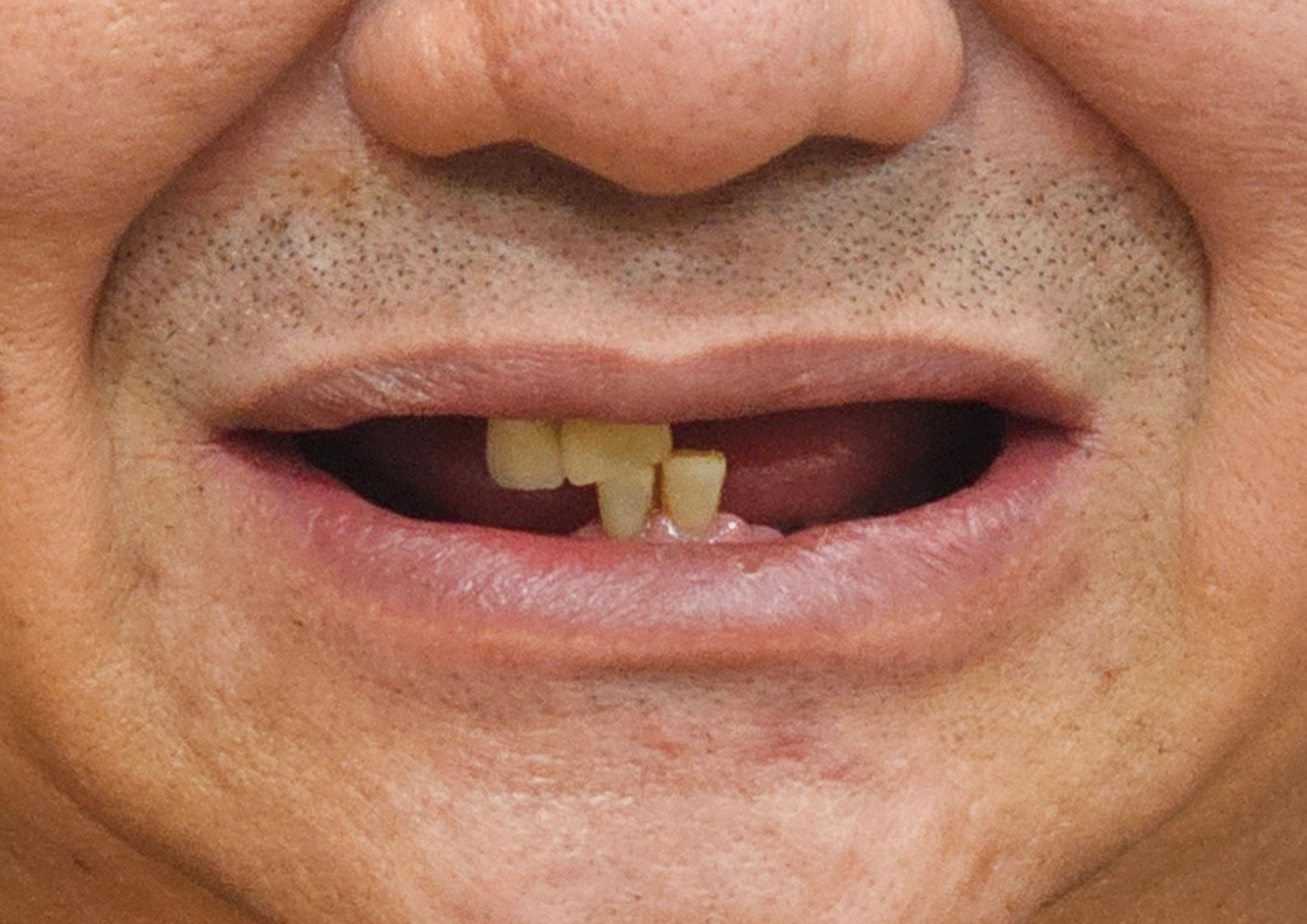 Before treatment