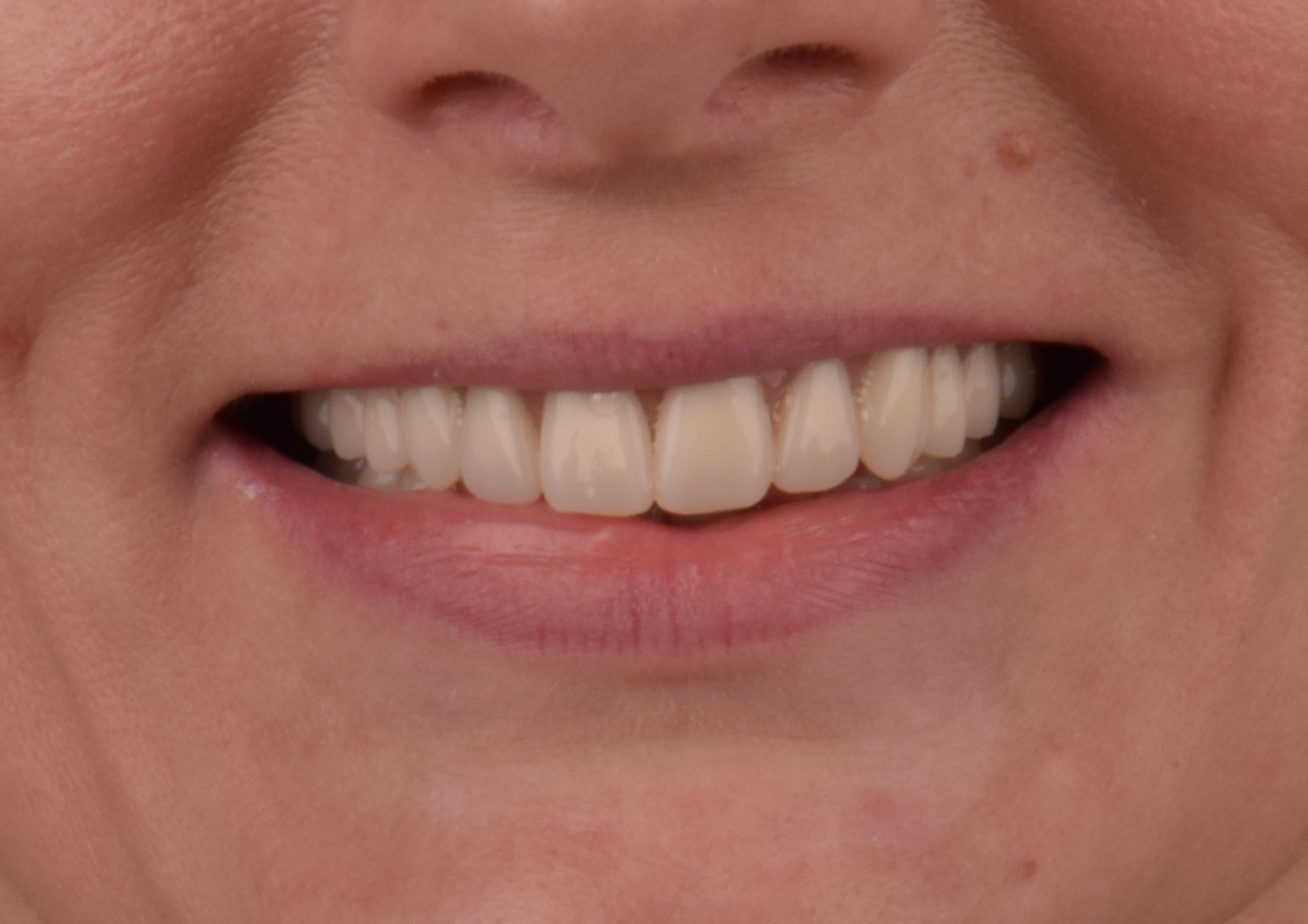 After dental treatment