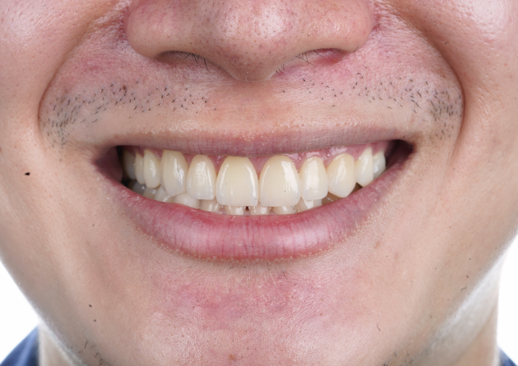 After dental treatment