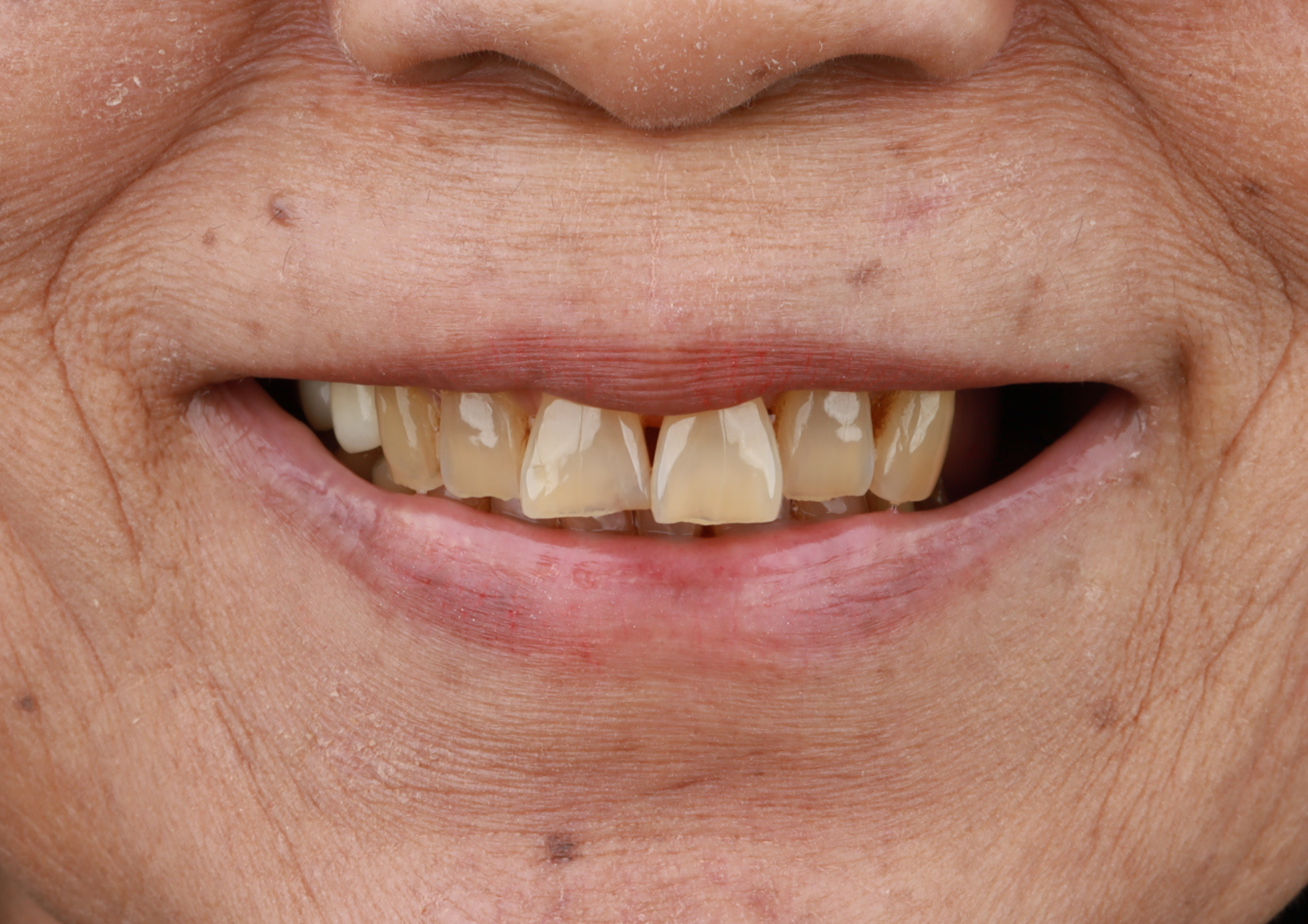 Before treatment
