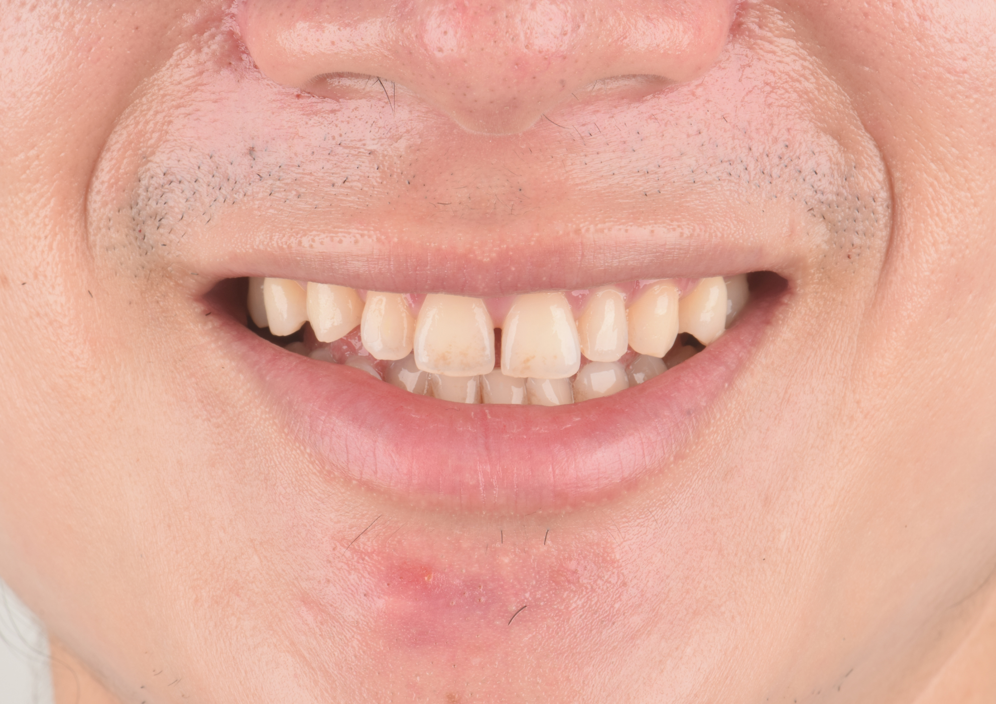 Before treatment