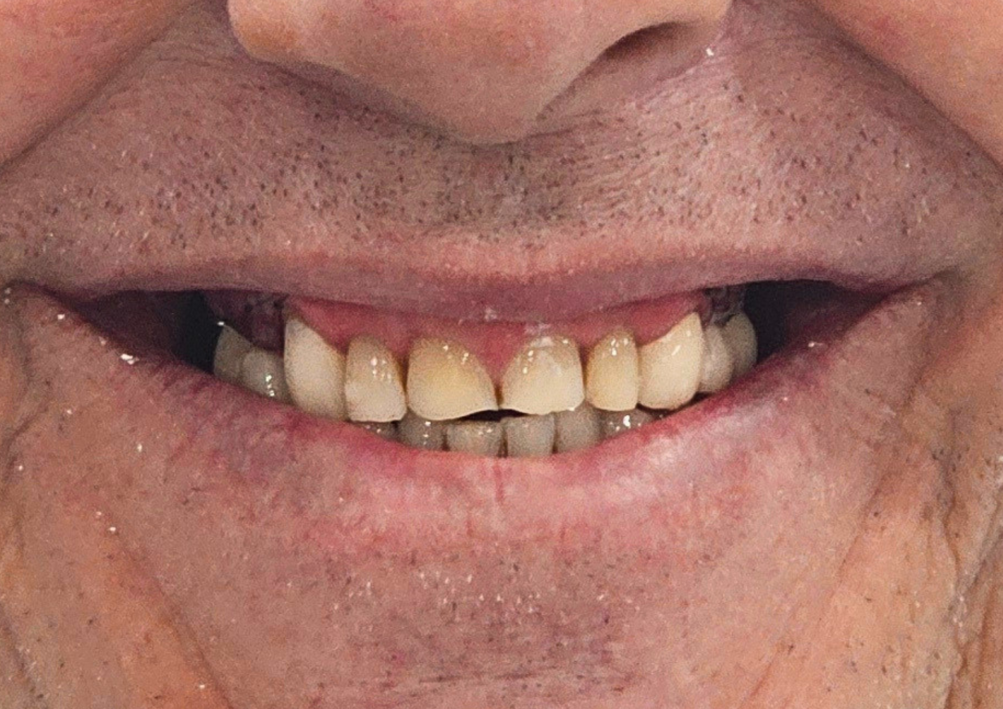 Before treatment