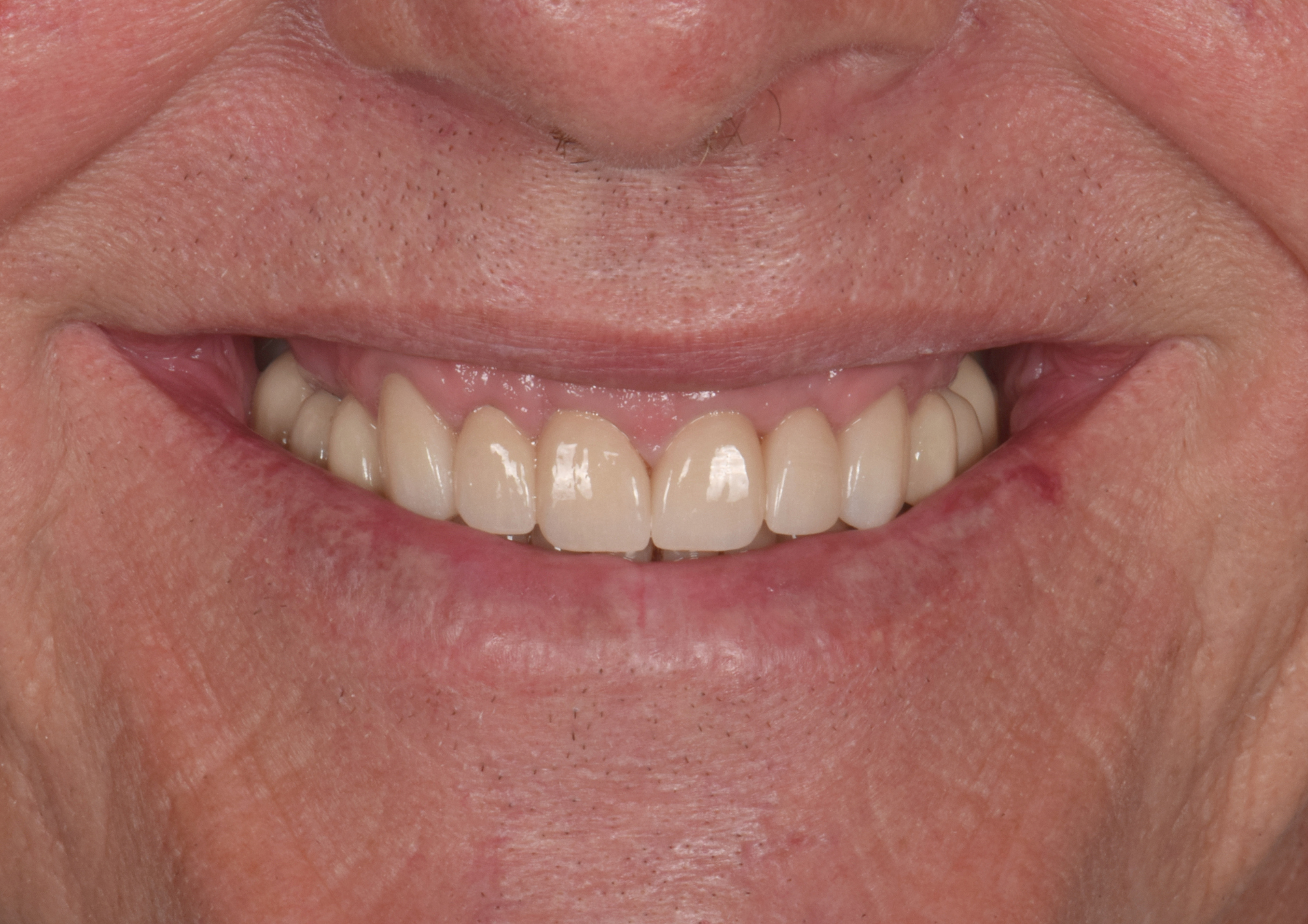 After dental treatment