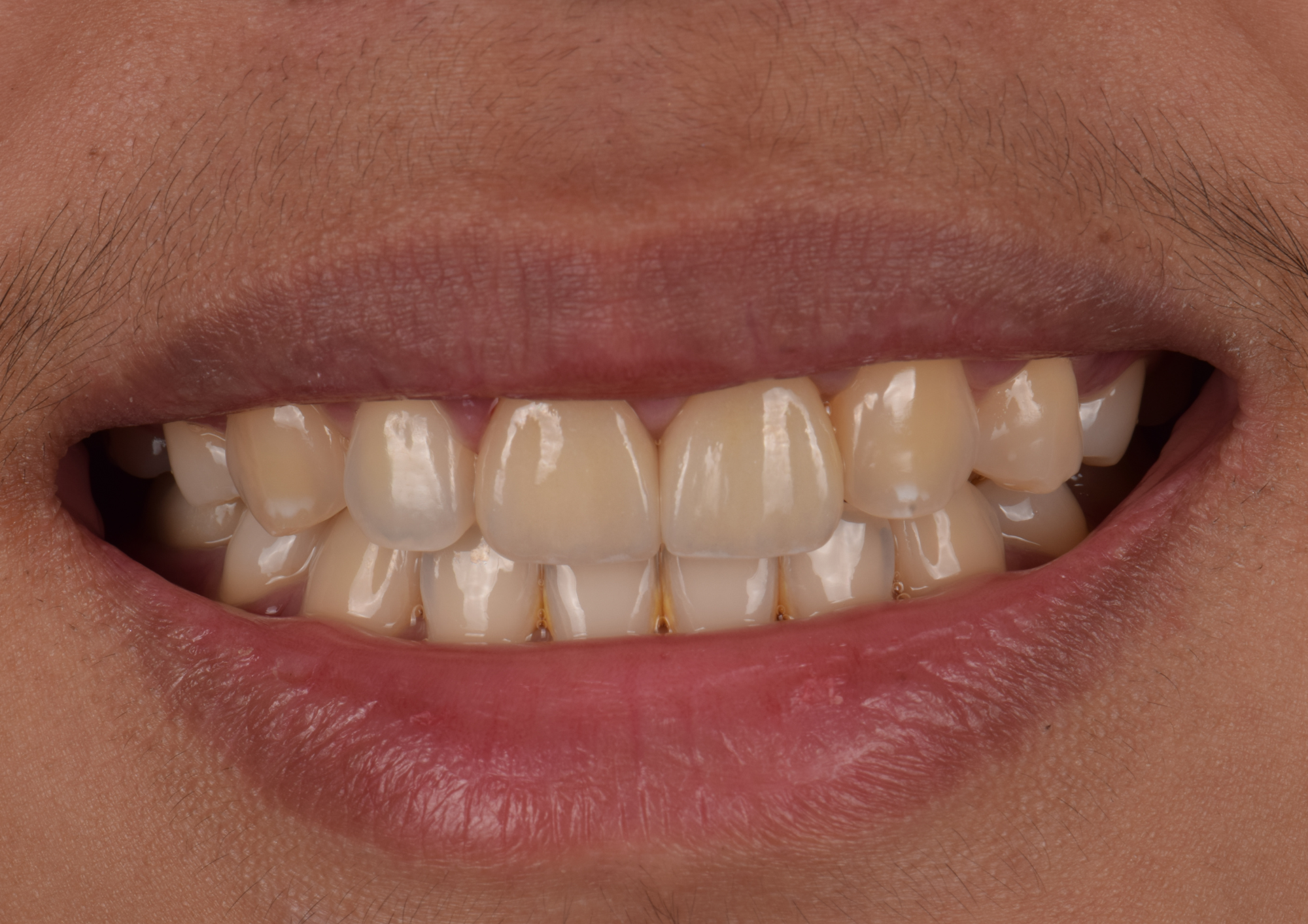 After dental treatment
