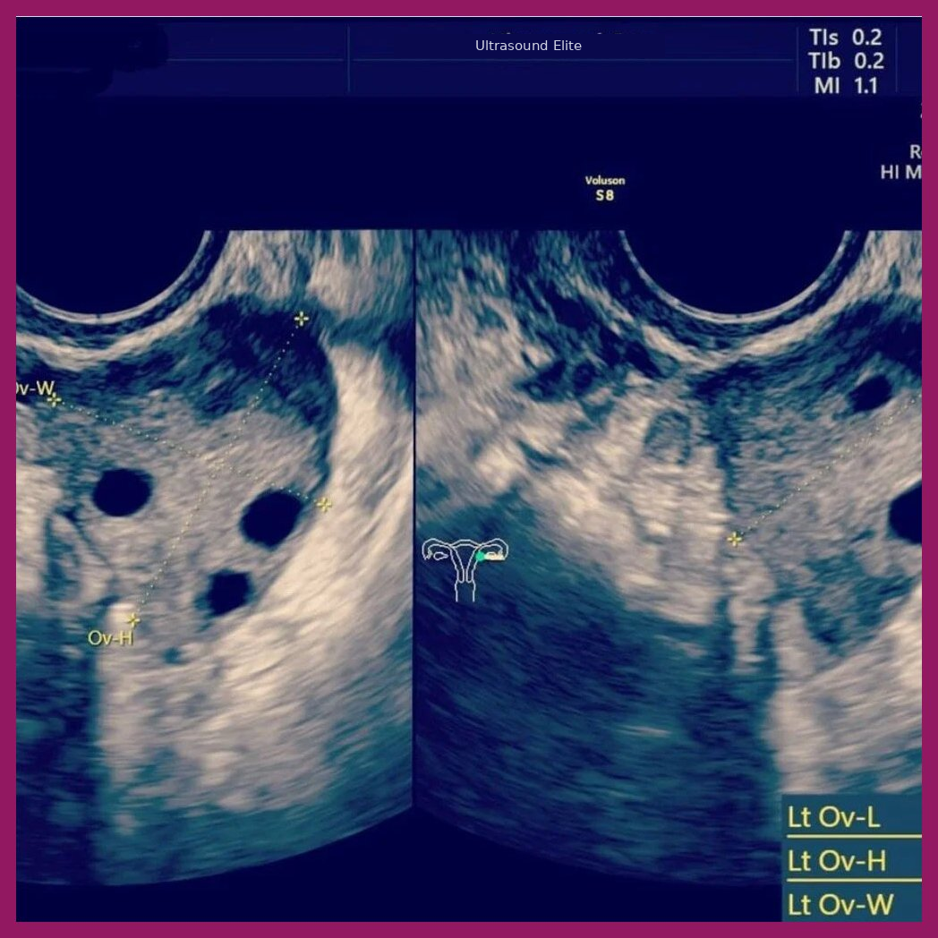 Gynae Pelvic Scan Cardiff
