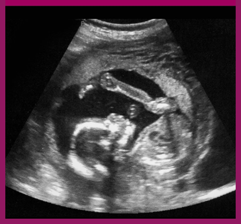 Gender Baby Scan Cardiff