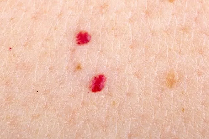 Laser treatment for cherry angiomas at Dr. B MedSpa in Bend, Oregon