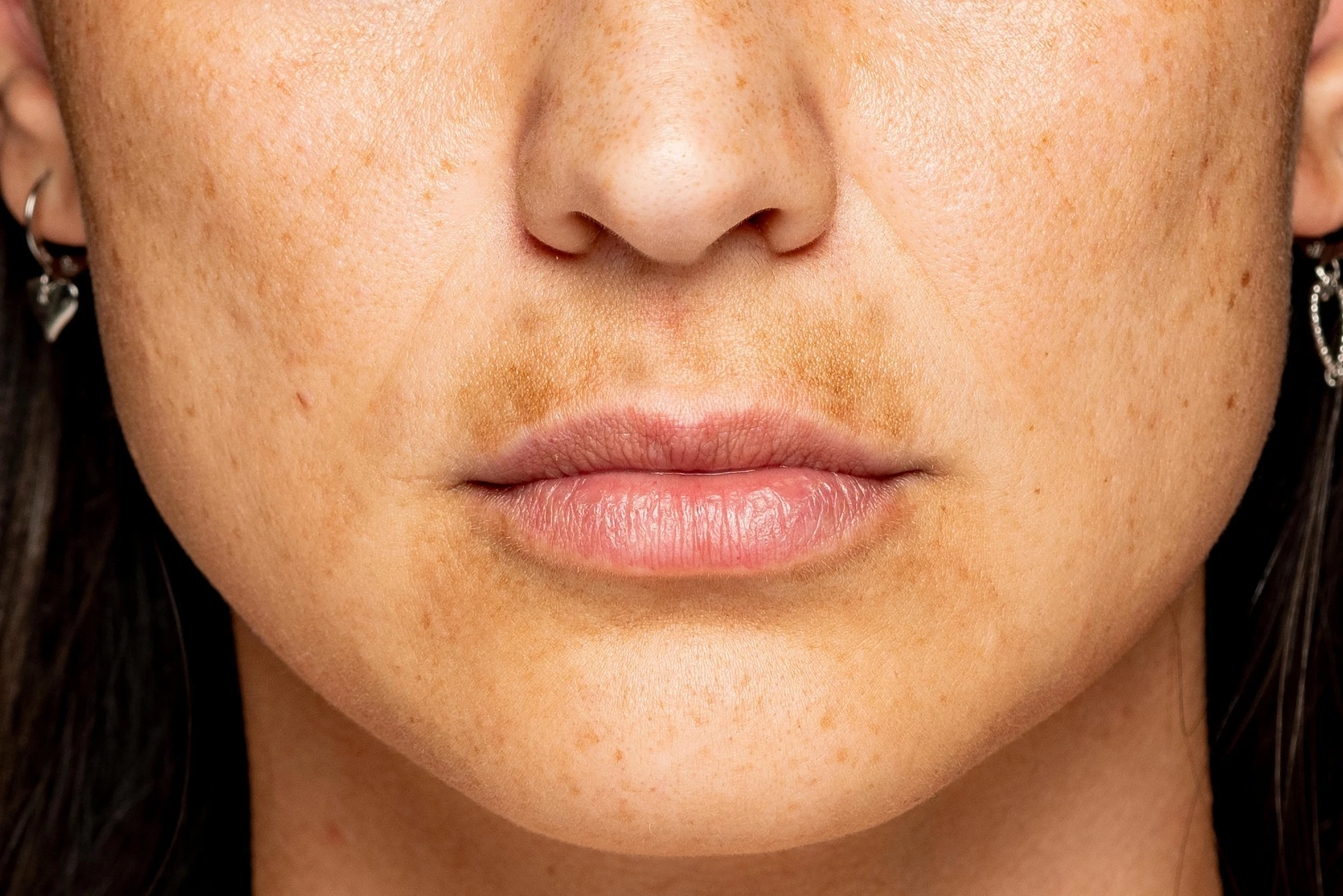Laser treatment for hyperpigmentation at Dr. B MedSpa in Bend, Oregon