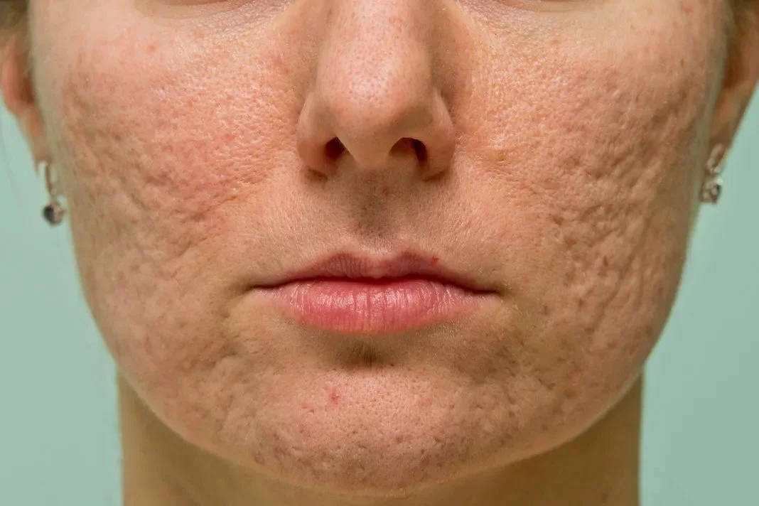 Laser scar treatment at Dr. B MedSpa in Bend, Oregon