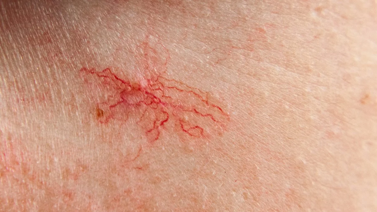 Laser treatment for vascular lesions at Dr. B MedSpa in Bend, Oregon