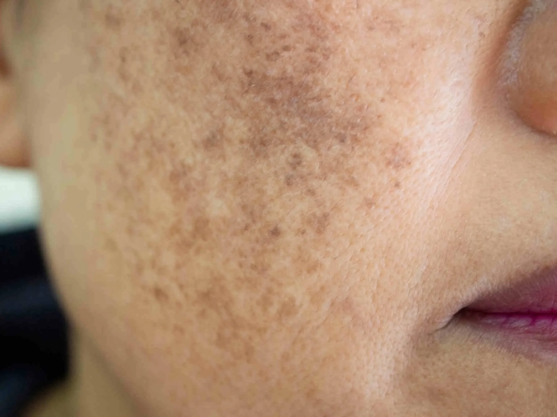 Advanced laser melasma treatment at Dr. B MedSpa in Bend, Oregon