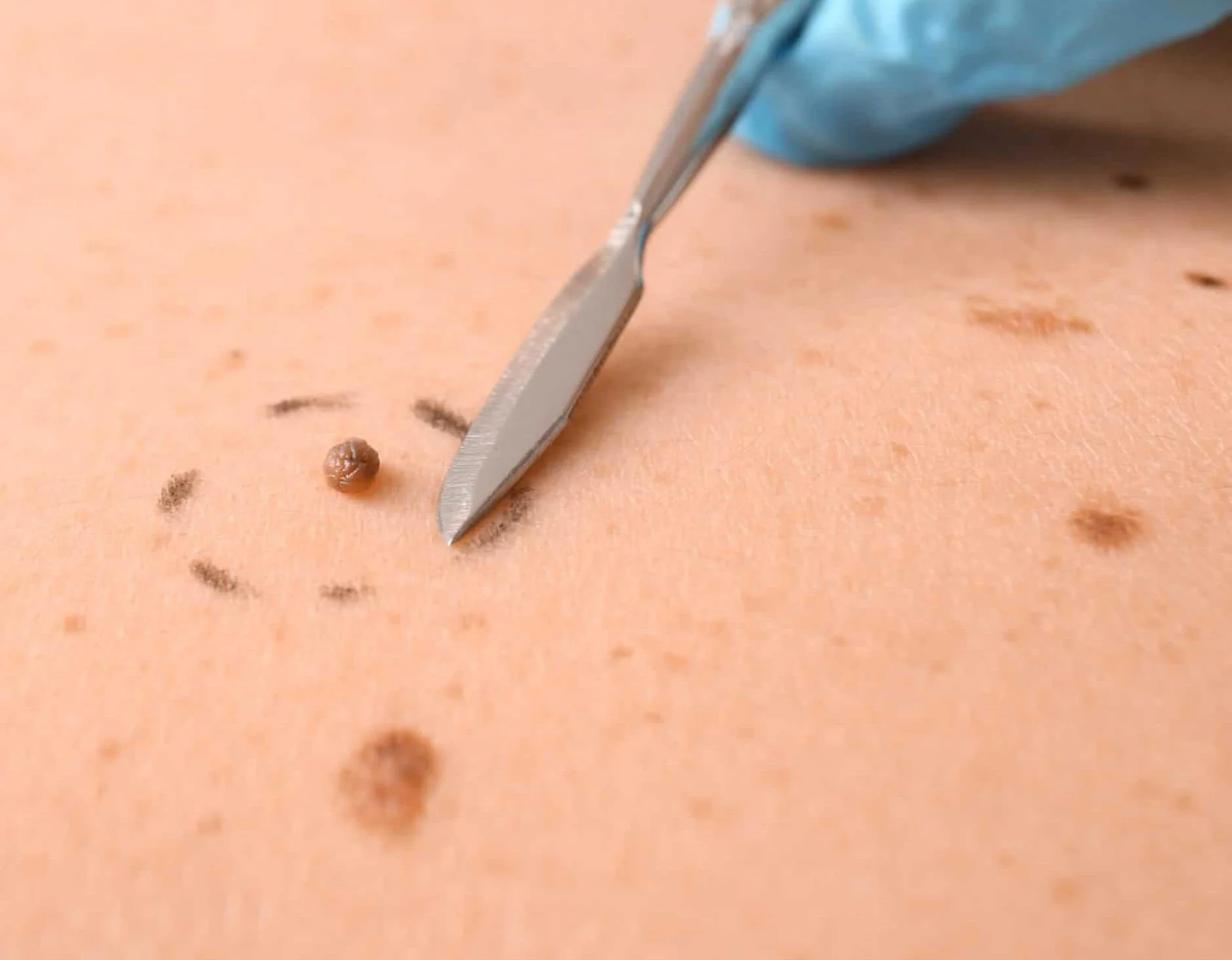 Physician performing skin tag and mole removal at Dr. B MedSpa in Bend, Oregon