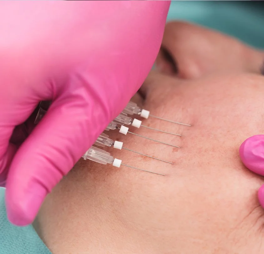 PDO Smooth Threads skin tightening treatment at Dr. B MedSpa in Bend, Oregon
