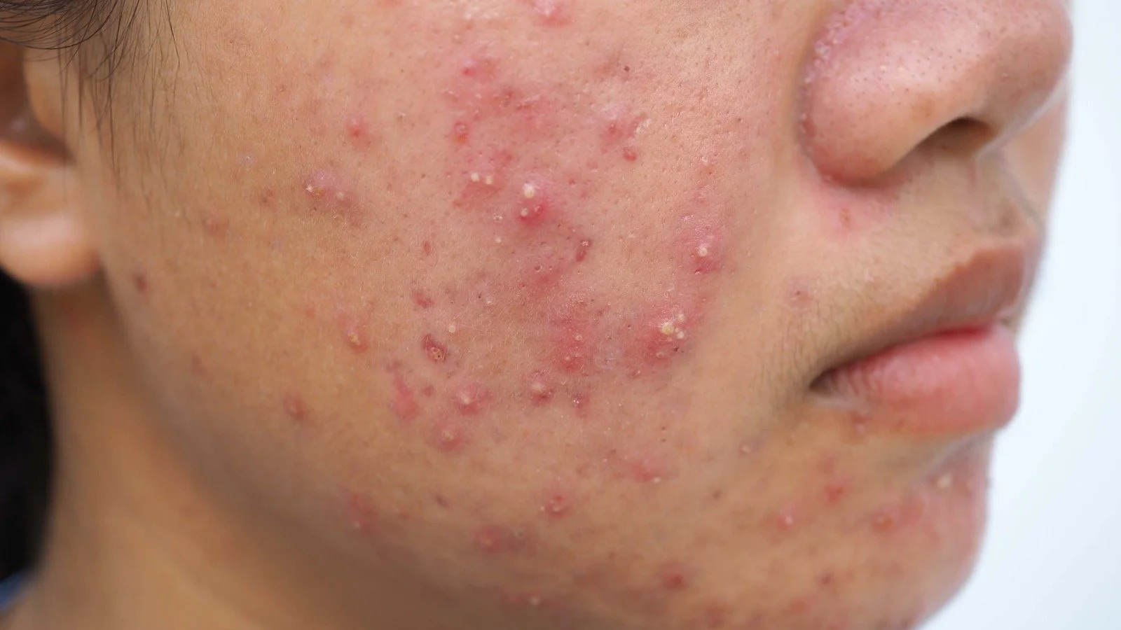 Advanced laser acne treatment at Dr. B MedSpa in Bend, Oregon