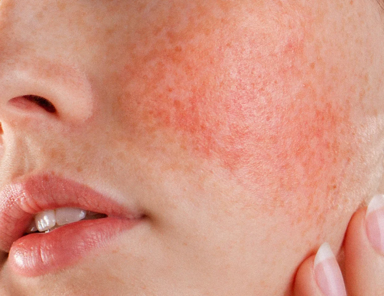 Advanced laser rosacea treatment at Dr. B MedSpa in Bend, Oregon